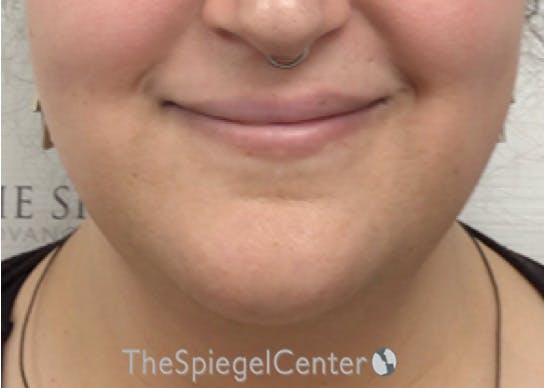 Mandible Contouring Before & After Gallery - Patient 194300 - Image 1