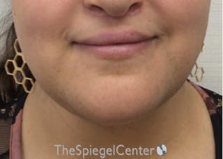 Mandible Contouring Before & After Gallery - Patient 194300 - Image 2