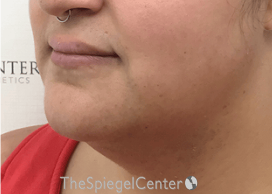 Mandible Contouring Before & After Gallery - Patient 194300 - Image 3
