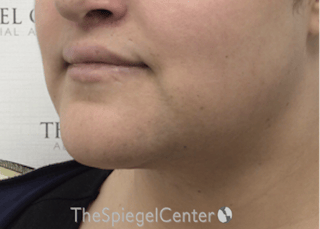 Mandible Contouring Before & After Gallery - Patient 194300 - Image 4