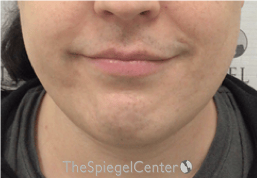 FFS Mandible Contouring Before & After Gallery - Patient 224433 - Image 1
