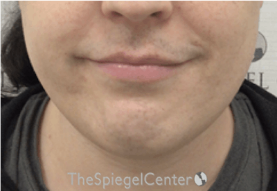 FFS Mandible Contouring Before & After Gallery - Patient 224433 - Image 1