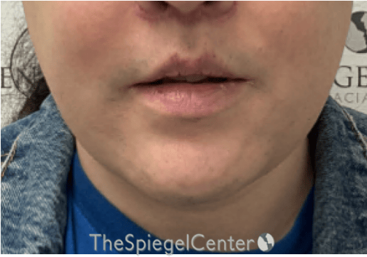 FFS Mandible Contouring Before & After Gallery - Patient 224433 - Image 2