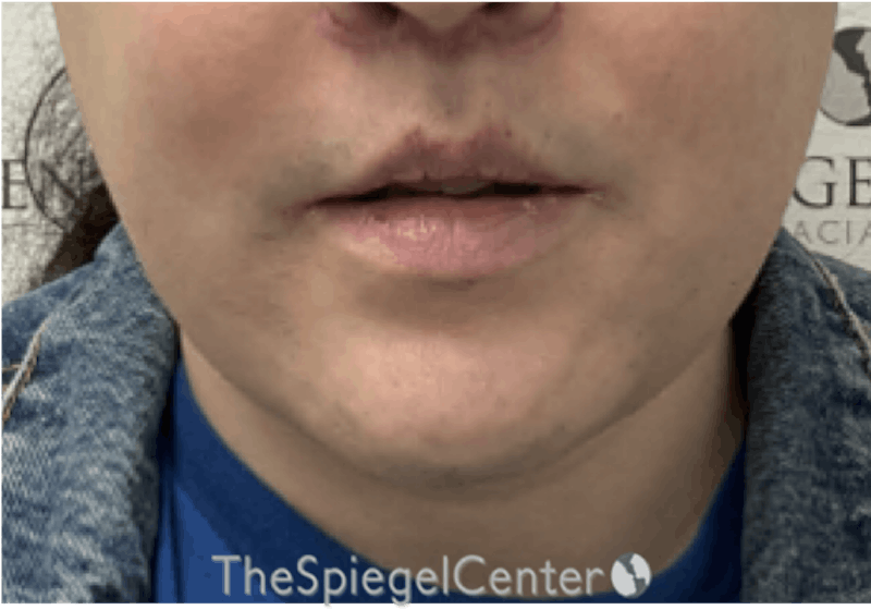 Mandible Contouring Before & After Gallery - Patient 185833 - Image 2