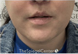 Mandible Contouring Before & After Gallery - Patient 185833 - Image 2
