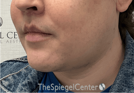 FFS Mandible Contouring Before & After Gallery - Patient 224433 - Image 4