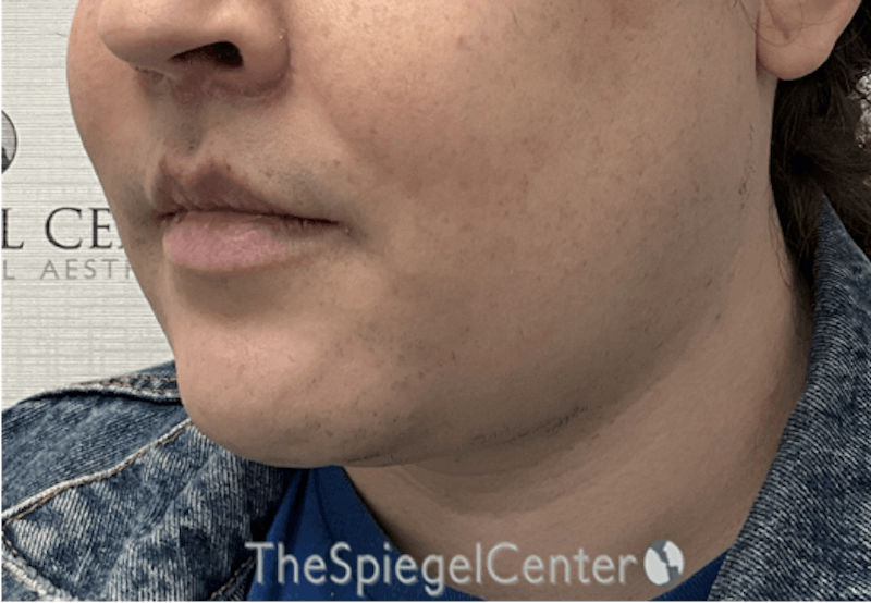 Mandible Contouring Before & After Gallery - Patient 185833 - Image 4