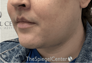 Mandible Contouring Before & After Gallery - Patient 185833 - Image 4