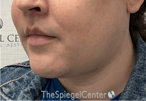 FFS Mandible Contouring Before & After Gallery - Patient 224433 - Image 4
