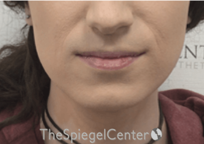 Mandible Contouring Before & After Gallery - Patient 290567 - Image 1