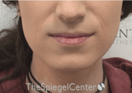 Mandible Contouring Before & After Gallery - Patient 290567 - Image 1