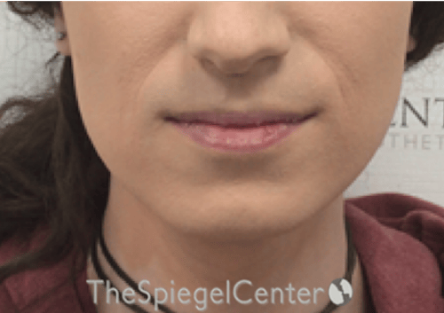 FFS Mandible Contouring Before & After Gallery - Patient 620210 - Image 1