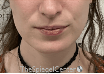 FFS Mandible Contouring Before & After Gallery - Patient 620210 - Image 2