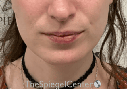 Mandible Contouring Before & After Gallery - Patient 290567 - Image 2