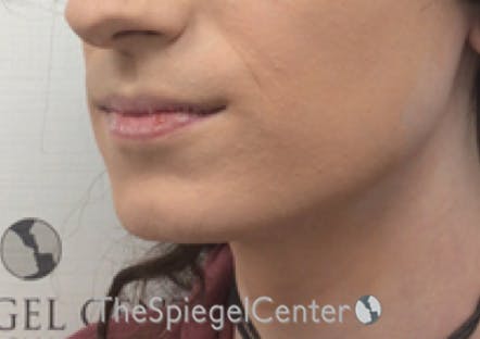 Mandible Contouring Before & After Gallery - Patient 290567 - Image 3