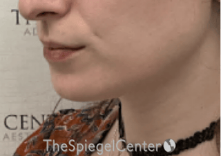 Mandible Contouring Before & After Gallery - Patient 290567 - Image 4