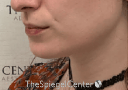 Mandible Contouring Before & After Gallery - Patient 290567 - Image 4
