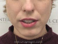 Mandible Contouring Before & After Gallery - Patient 125633 - Image 1