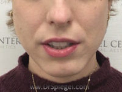 FFS Mandible Contouring Before & After Gallery - Patient 323352 - Image 1