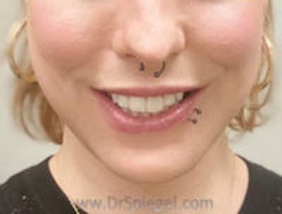 FFS Mandible Contouring Before & After Gallery - Patient 323352 - Image 2