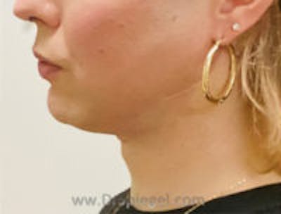 FFS Mandible Contouring Before & After Gallery - Patient 323352 - Image 4