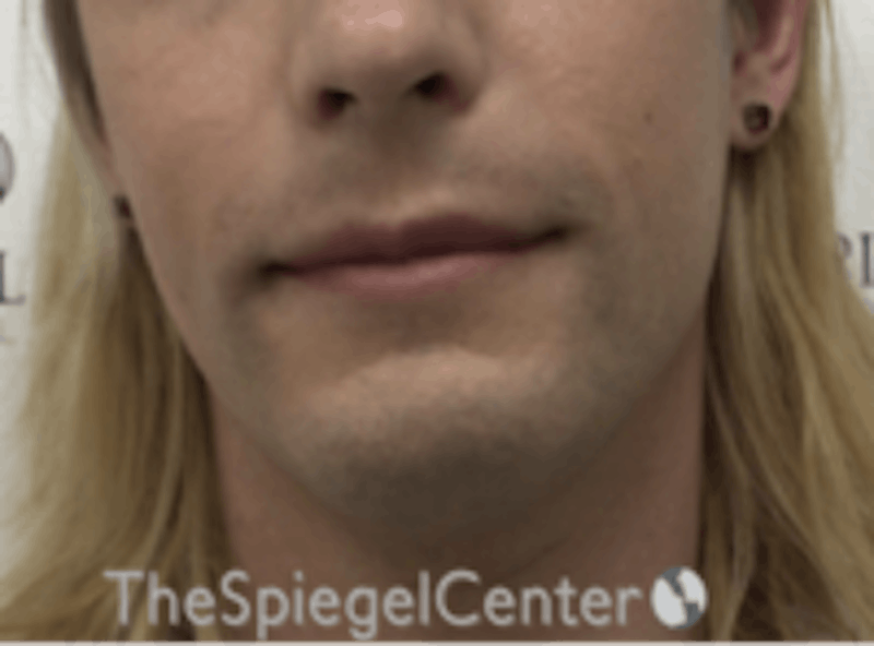 FFS Mandible Contouring Before & After Gallery - Patient 554604 - Image 1