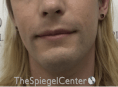 FFS Mandible Contouring Before & After Gallery - Patient 554604 - Image 1