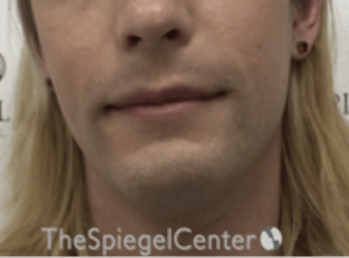 FFS Mandible Contouring Before & After Gallery - Patient 554604 - Image 1