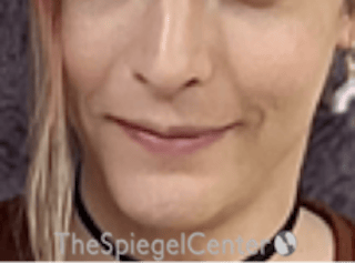 Mandible Contouring Before & After Gallery - Patient 697508 - Image 2