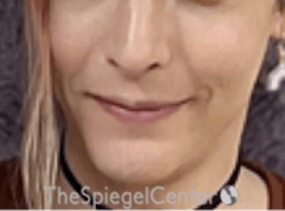 FFS Mandible Contouring Before & After Gallery - Patient 554604 - Image 2