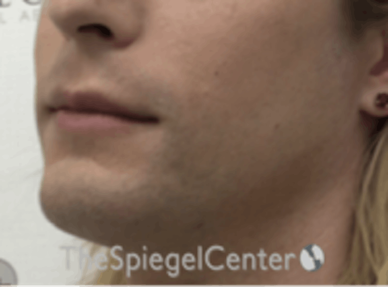 FFS Mandible Contouring Before & After Gallery - Patient 554604 - Image 3