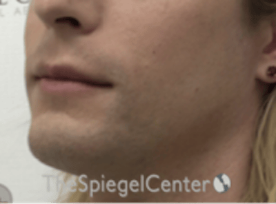 FFS Mandible Contouring Before & After Gallery - Patient 554604 - Image 3