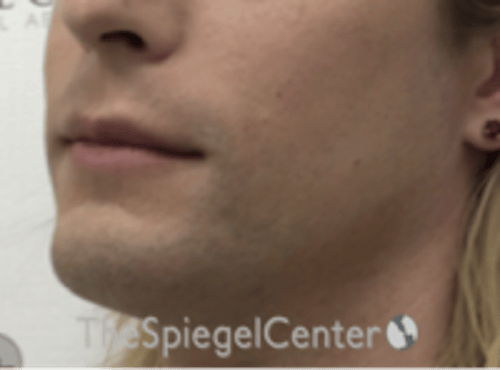 FFS Mandible Contouring Before & After Gallery - Patient 554604 - Image 3