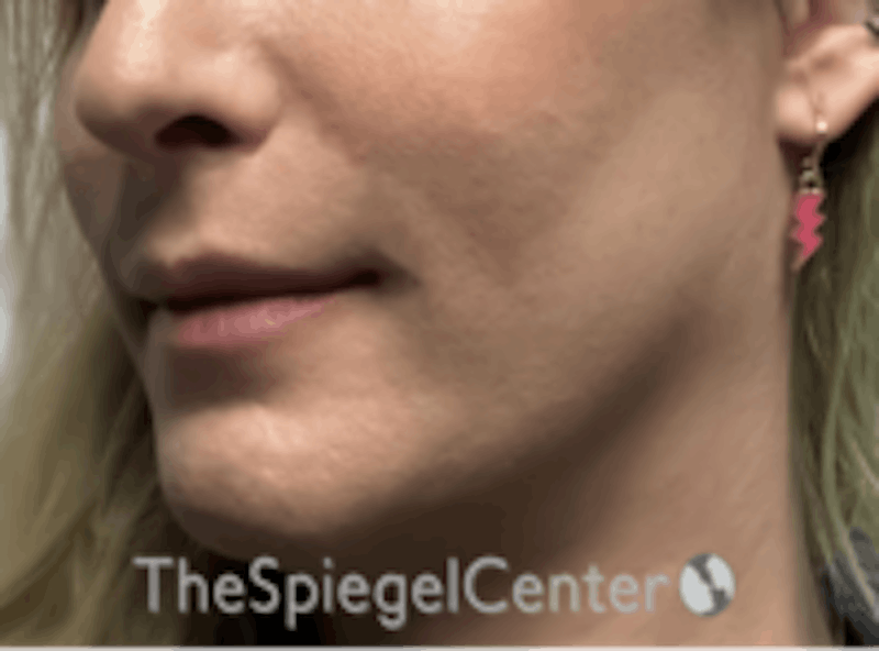 FFS Mandible Contouring Before & After Gallery - Patient 554604 - Image 4