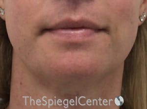 FFS Mandible Contouring Before & After Gallery - Patient 277567 - Image 2