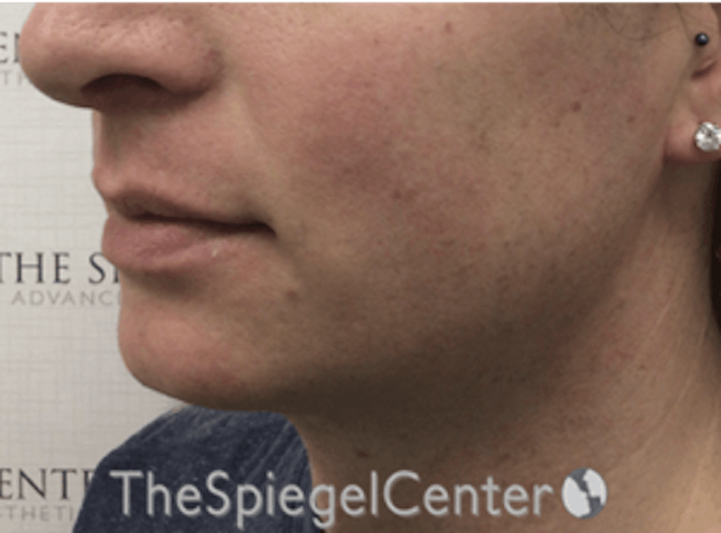 Mandible Contouring Before & After Gallery - Patient 333848 - Image 3