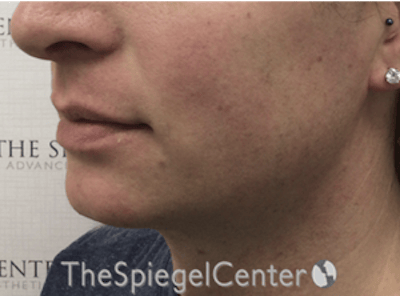 FFS Mandible Contouring Before & After Gallery - Patient 277567 - Image 3