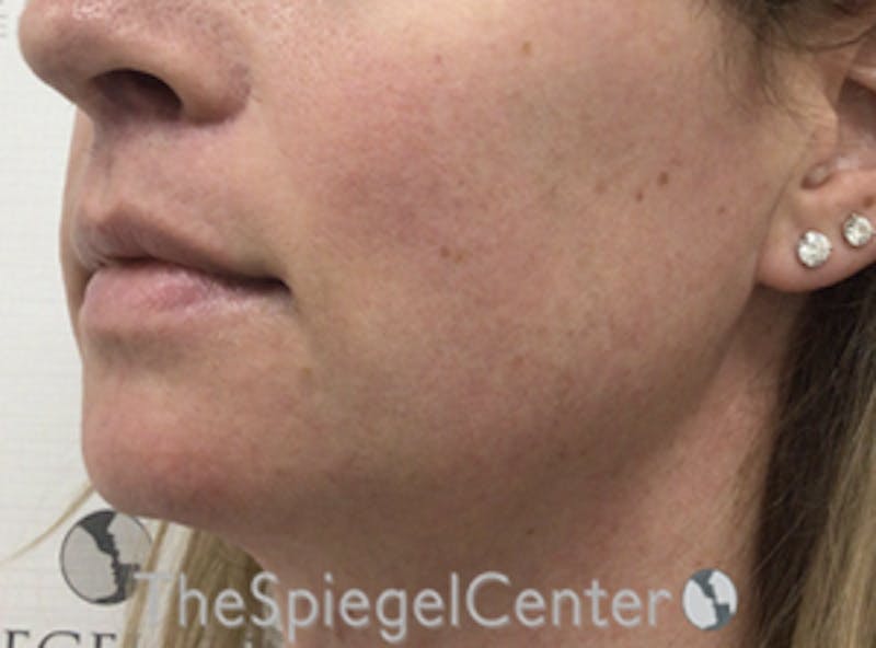 Mandible Contouring Before & After Gallery - Patient 333848 - Image 4