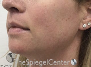Mandible Contouring Before & After Gallery - Patient 333848 - Image 4