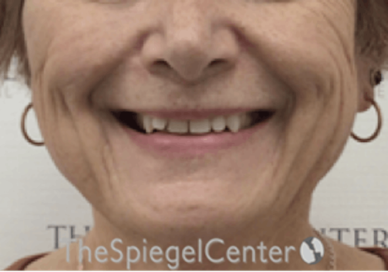 Mandible Contouring Before & After Gallery - Patient 846711 - Image 1