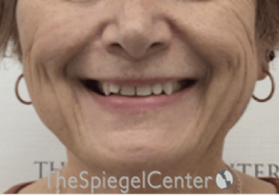 FFS Mandible Contouring Before & After Gallery - Patient 187282 - Image 1