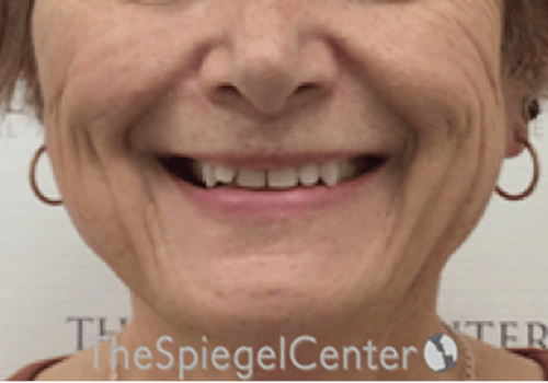 FFS Mandible Contouring Before & After Gallery - Patient 187282 - Image 1