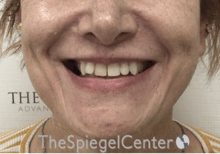 Mandible Contouring Before & After Gallery - Patient 846711 - Image 2