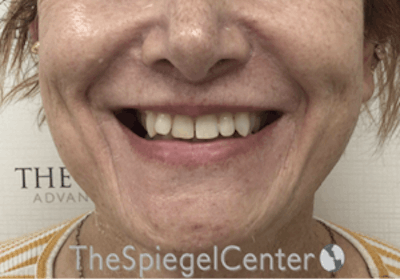 FFS Mandible Contouring Before & After Gallery - Patient 187282 - Image 2