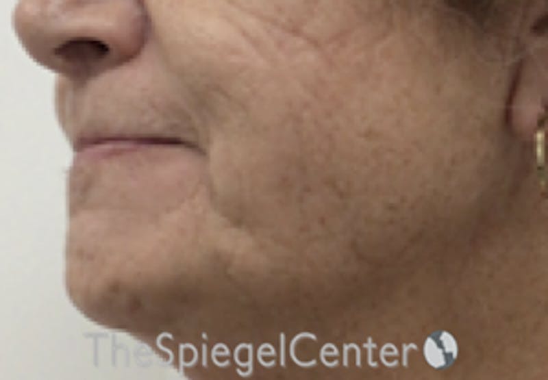Mandible Contouring Before & After Gallery - Patient 846711 - Image 3