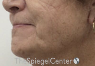 FFS Mandible Contouring Before & After Gallery - Patient 187282 - Image 3