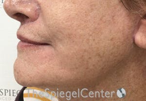 Mandible Contouring Before & After Gallery - Patient 846711 - Image 4
