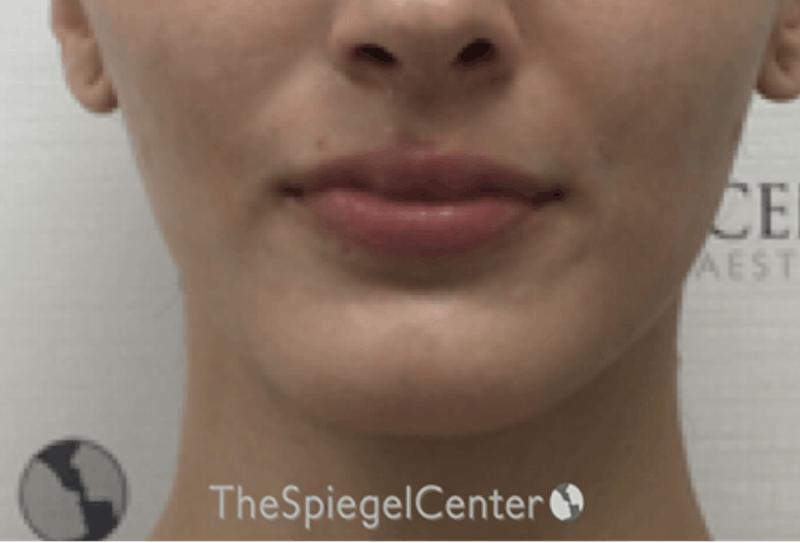 Mandible Contouring Before & After Gallery - Patient 360298 - Image 1