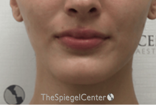 FFS Mandible Contouring Before & After Gallery - Patient 271524 - Image 1