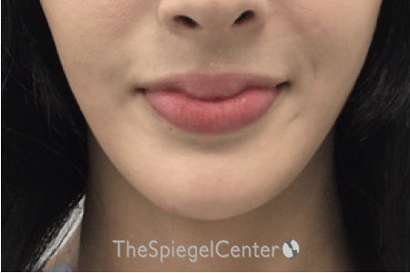 FFS Mandible Contouring Before & After Gallery - Patient 271524 - Image 2